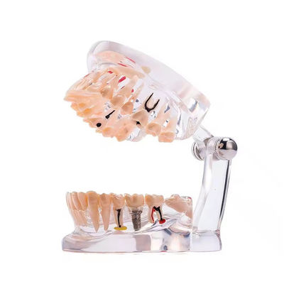 32 Ząb Pełny miesiąc Choroba implantu Model zębów Jasny projekt Patologia stomatologiczna Model